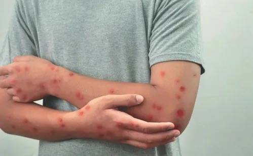 Brasil registra 81 casos de mpox em 2026; S�o Paulo lidera notifica��es